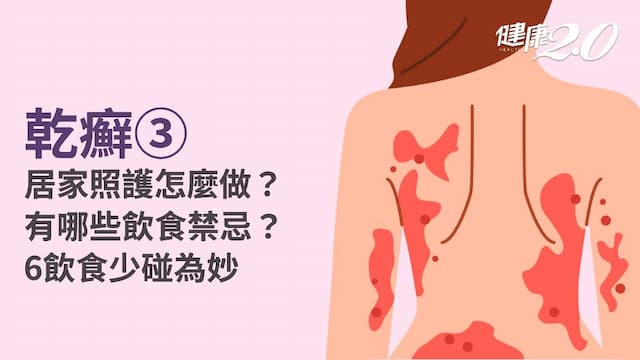 乾癬／乾癬可以根治嗎？該如何預防乾癬復發？3食物抗發炎