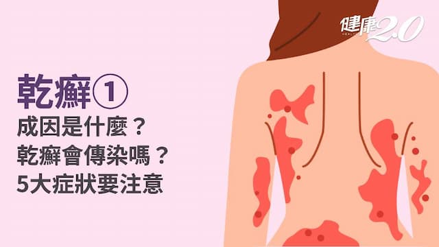 乾癬／乾癬是什麼？乾癬症狀、併發症有哪些？6類型乾癬一次看