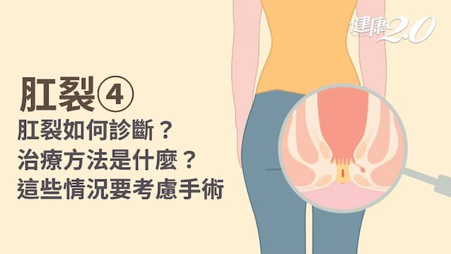 肛裂／肛裂怎麼辦？治療要用藥膏還是手術？8成這樣做能痊癒