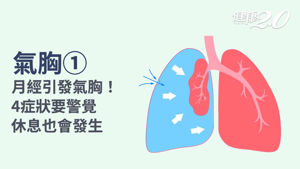氣胸／氣胸有哪些症狀？月經來也會氣胸？1情況恐導致死亡