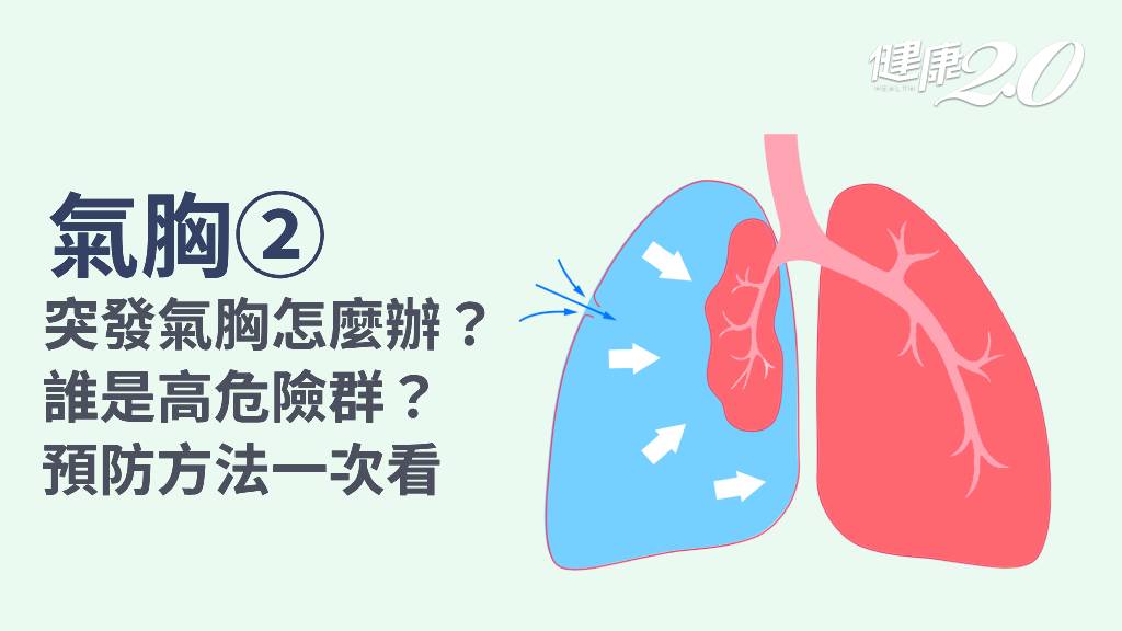 氣胸／誰是氣胸高危險群？哪些因素會誘發氣胸？預防氣胸生活對策
