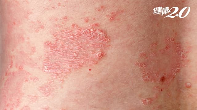 皮膚病也會致命！全身長滿膿疱恐敗血症 7/1健保給付新藥救命