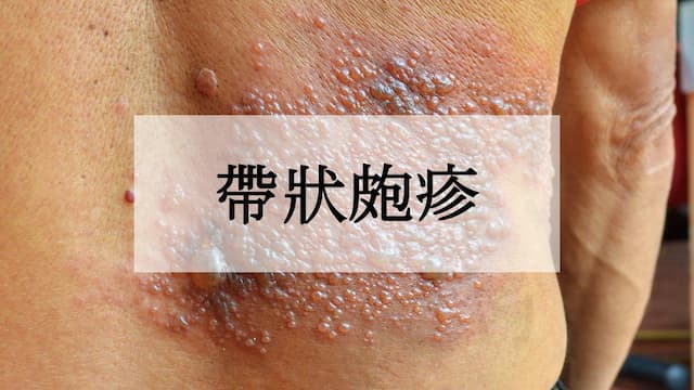 帶狀皰疹多久會好？帶狀皰疹疫苗費用和症狀一次看