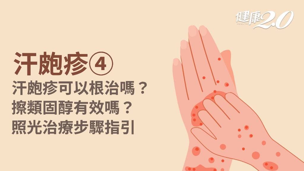 汗皰疹／汗皰疹如何診斷治療？汗皰疹藥膏推薦？1治療很有效