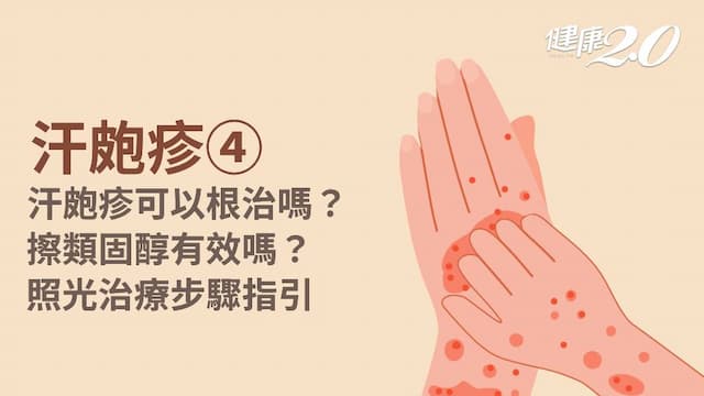 汗皰疹／汗皰疹如何診斷治療？<span style="color:#1BA42B;">汗皰疹藥膏</span>推薦？1治療很有效