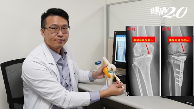50歲婦膝關節退化 這款手術免換人工關節還可矯正O型腿、軟骨再生