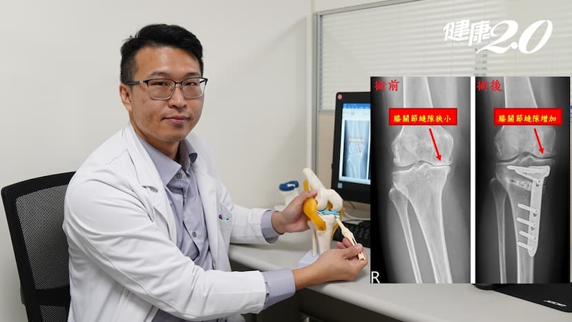 50歲婦膝關節退化 這款手術免換人工關節還可矯正O型腿、軟骨再生/strong/349129