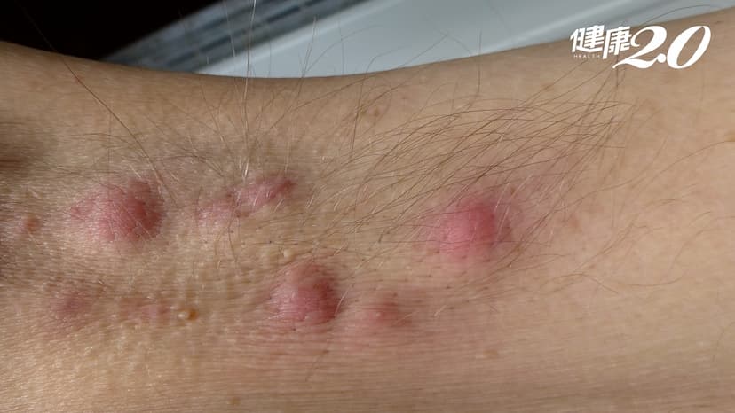 毛囊炎又復發？除毛前忘做2件事就慘了 醫解析蜜蠟、雷射、除毛膏哪個好/medical/349135