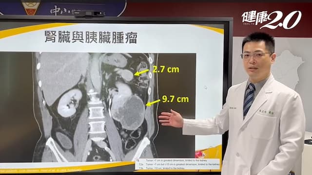 男反覆發燒腹痛 檢查驚見9.7公分大腫瘤