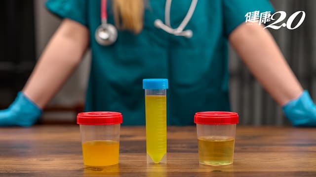 尿液變這顏色小心「肝膽異常」！尿液無色正常嗎？變琥珀色代表什麼？
