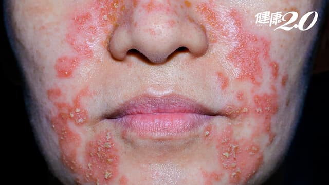 異位性皮膚炎大爆發「像螞蟻鑽骨」半夜癢醒！新藥納健保病友獲新生