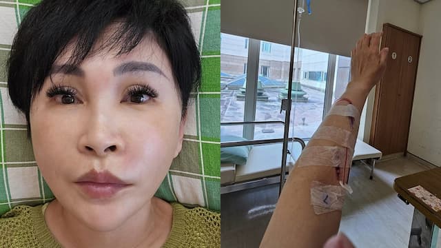 吃烤肉燙傷竟住院！王瑞玲臉部嚴重腫脹 醫：紅斑性狼瘡患者禁吃2食物