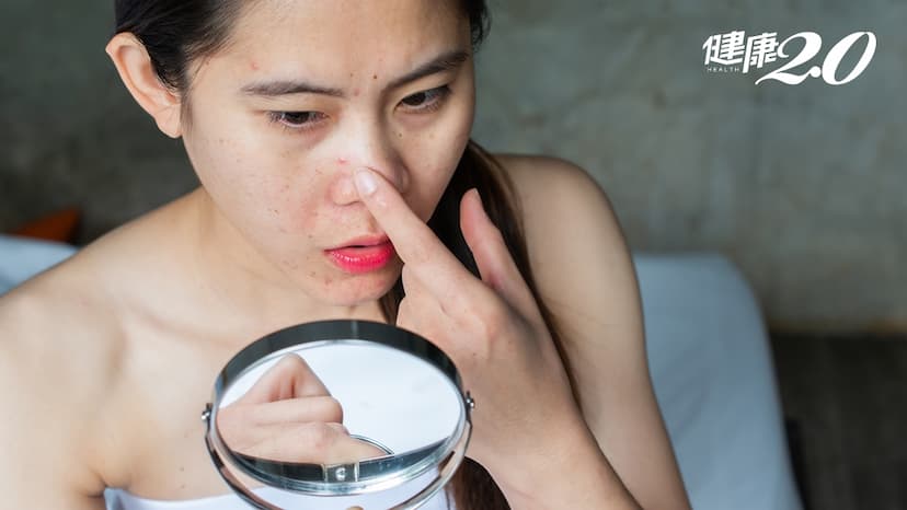 吃A酸治痘 忘記吃該不該補吃？會不會影響療效？吳明穎詳解補救方式/medical/350247