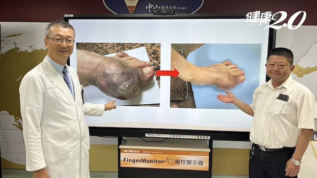 10年無法穿鞋！6旬男關節尿酸結晶大如馬鈴薯 只做「這件事」結晶縮小8成