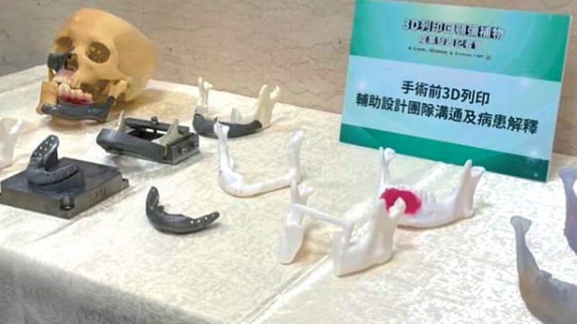 3D列印奇蹟！「客製彌補物」讓顏面重建更精準 口腔癌患重拾自信/cancer/350685