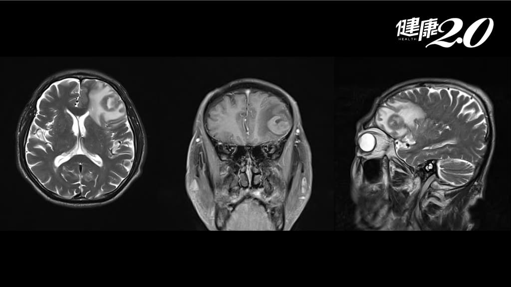 腦瘤-腦癌