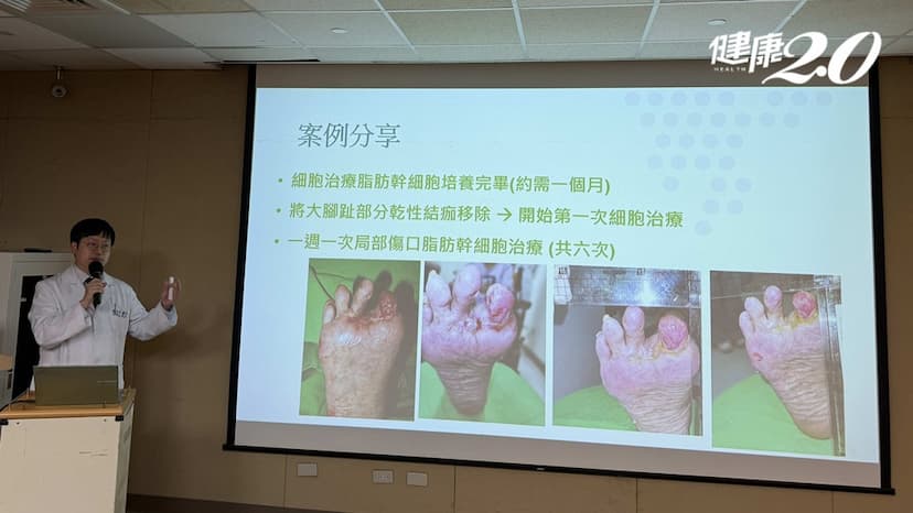 7旬糖尿病婦腳趾發黑！用脂肪讓傷口癒合 不用截肢了/medical/351100