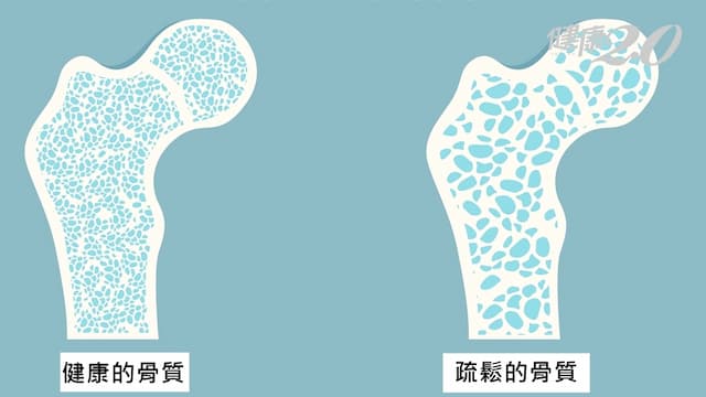 糖尿病易骨鬆？醫勸做好「這些事」不用擔心