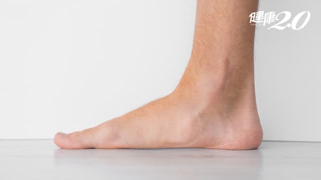 腳痛、扭傷不能拖！60歲奶奶慘「足弓消失」變後天性扁平足 醫曝4大危險因子