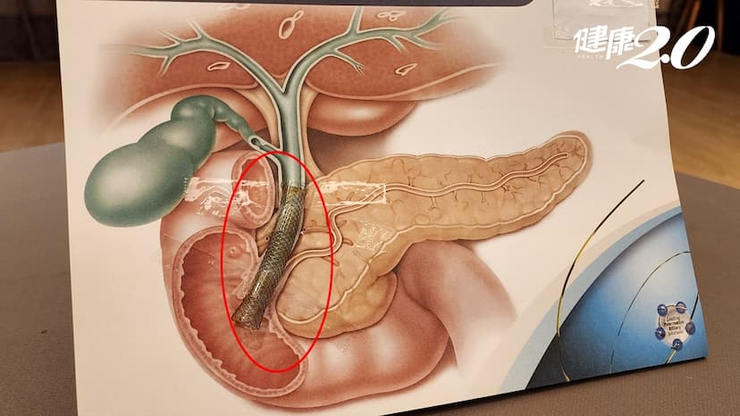 他腹脹、食慾不振竟是胰頭癌壓迫膽道！健保給付1支架順利改善/cancer/351715