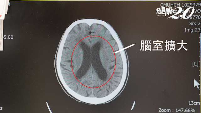 男走路不穩還尿失禁竟是腦內「這東西」過多 術後就改善/medical/351726