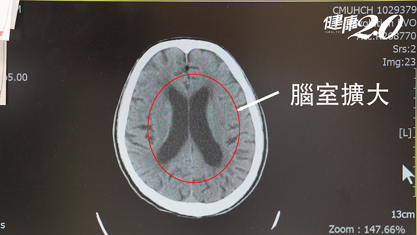 男走路不穩還尿失禁竟是腦內「這東西」過多 術後就改善/medical/351726