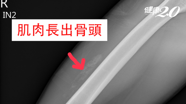 高中生打球「吃雞腿」 醫提醒「這少見情況」絕不可推拿