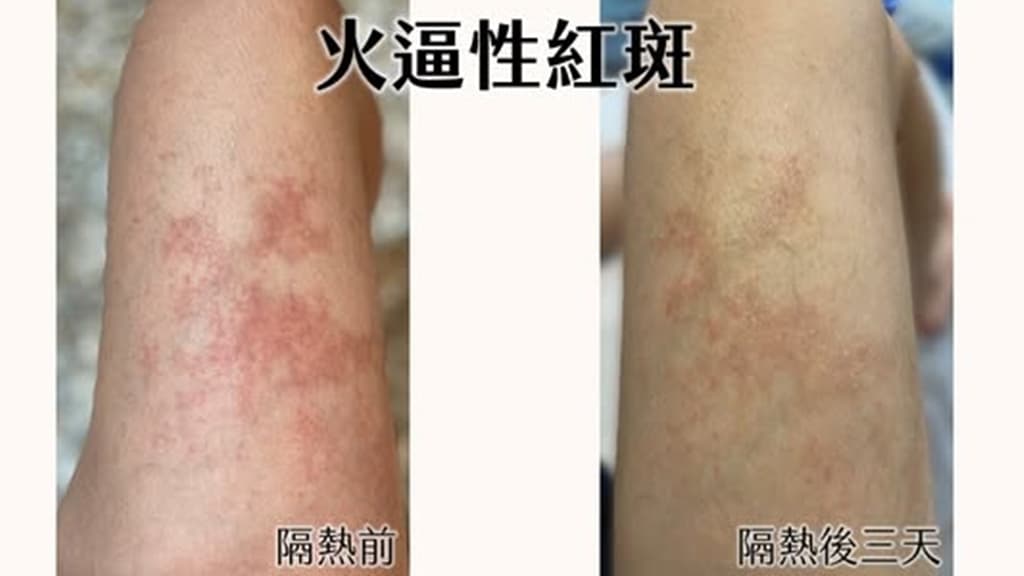 暖爐-皮膚紅斑