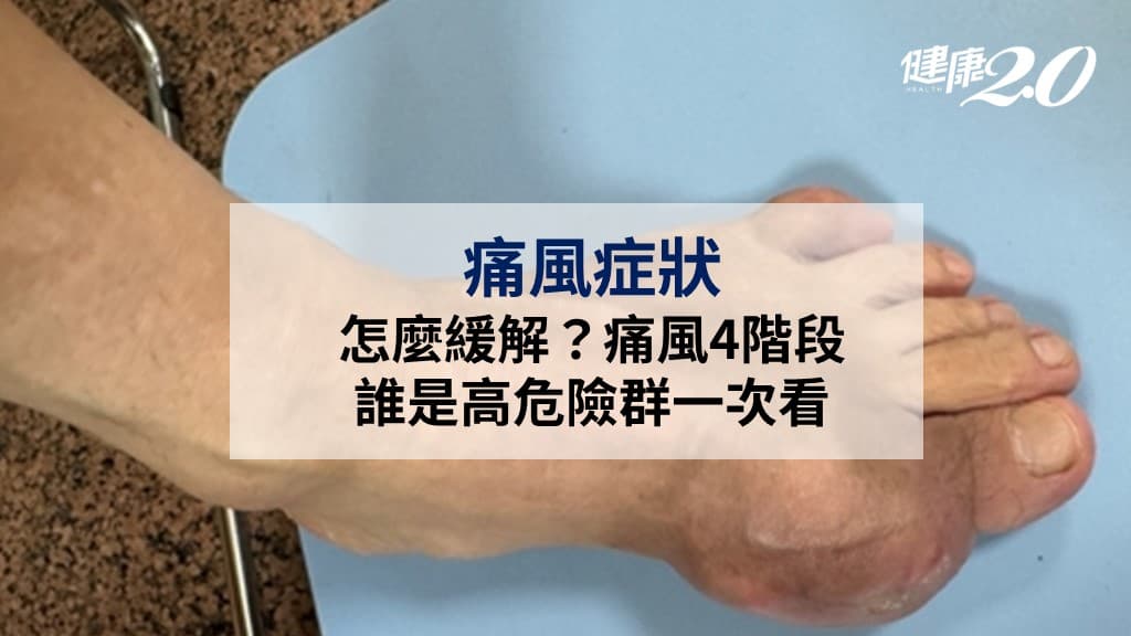 痛風症狀-痛風-尿酸