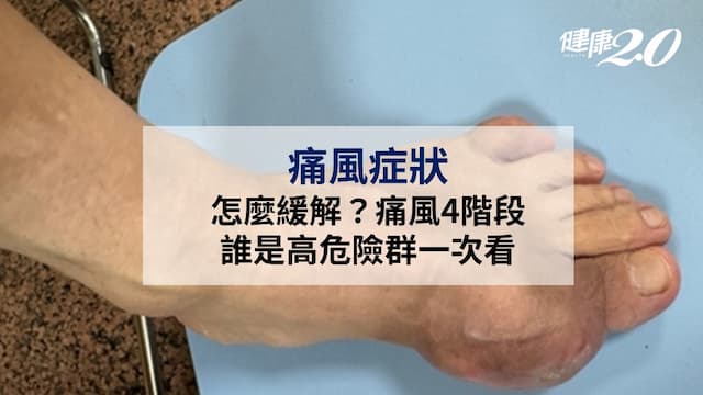 痛風症狀怎麼緩解？痛風4階段、誰是高危險群一次看