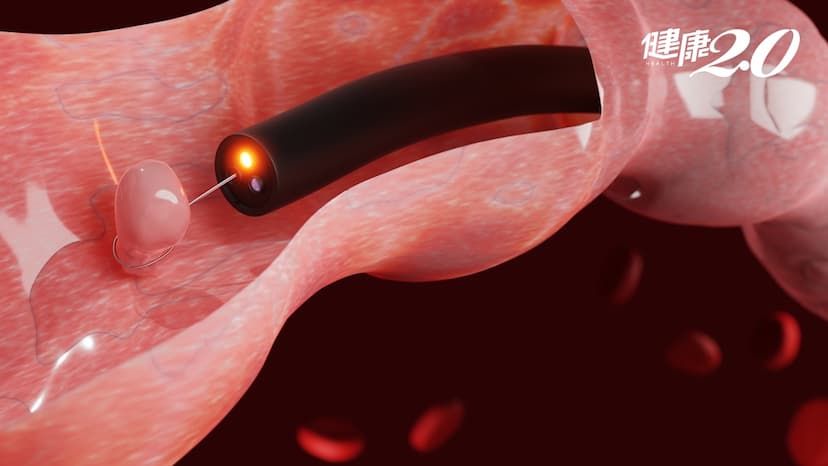你以為有做大腸鏡就沒事？小心「這種大腸癌」能悄悄避開檢查/cancer/352733