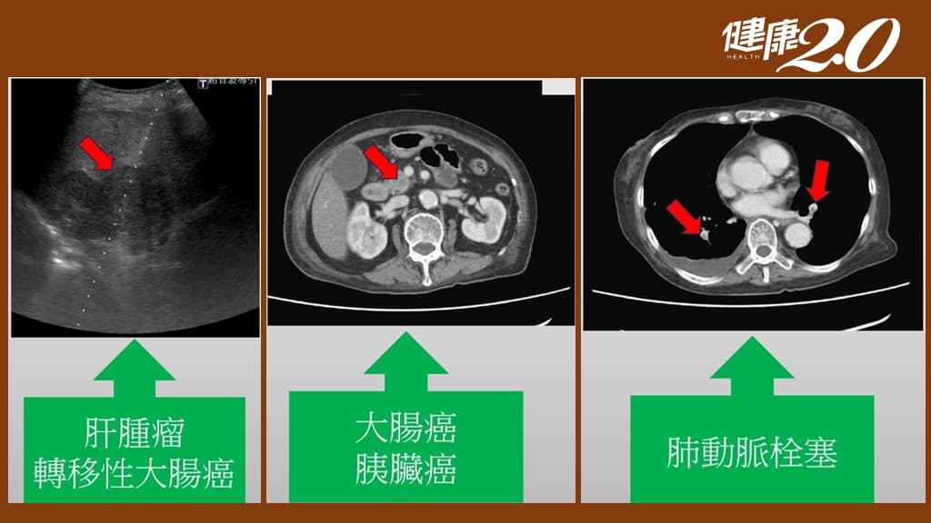 腸胃炎-大腸癌-胰臟癌-上吐下瀉