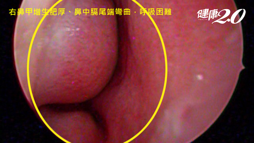 鼻塞塞成睡覺缺氧恐成心血管疾病！醫勸「這歲數以上」鼻塞最好做檢查/medical/352840