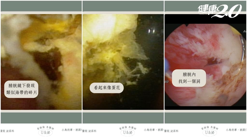 尿出海帶-長期便祕-大腸憩室炎-膀胱
