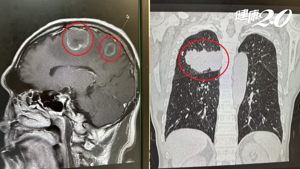 肺癌-腦轉移-腳無力-腦瘤