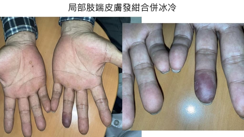 手指發紺-冰冷