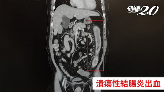 男上大號出血量大到休克！沒做「這件事」後果嚴重