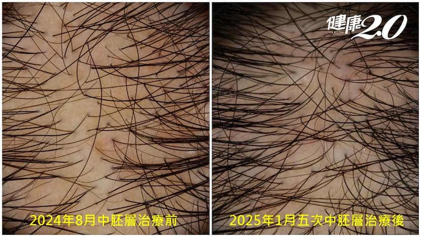 頭髮稀疏怎麼辦？新療法雙管齊下 藥物劑量、副作用雙降/medical/353219
