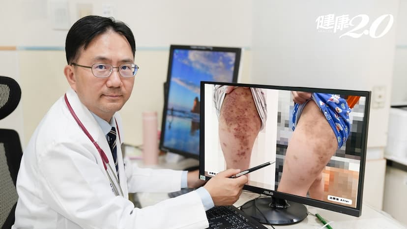 男童皮膚癢到睡不著、不敢上學 醫推2方法明顯改善異位性皮膚炎/medical/353694