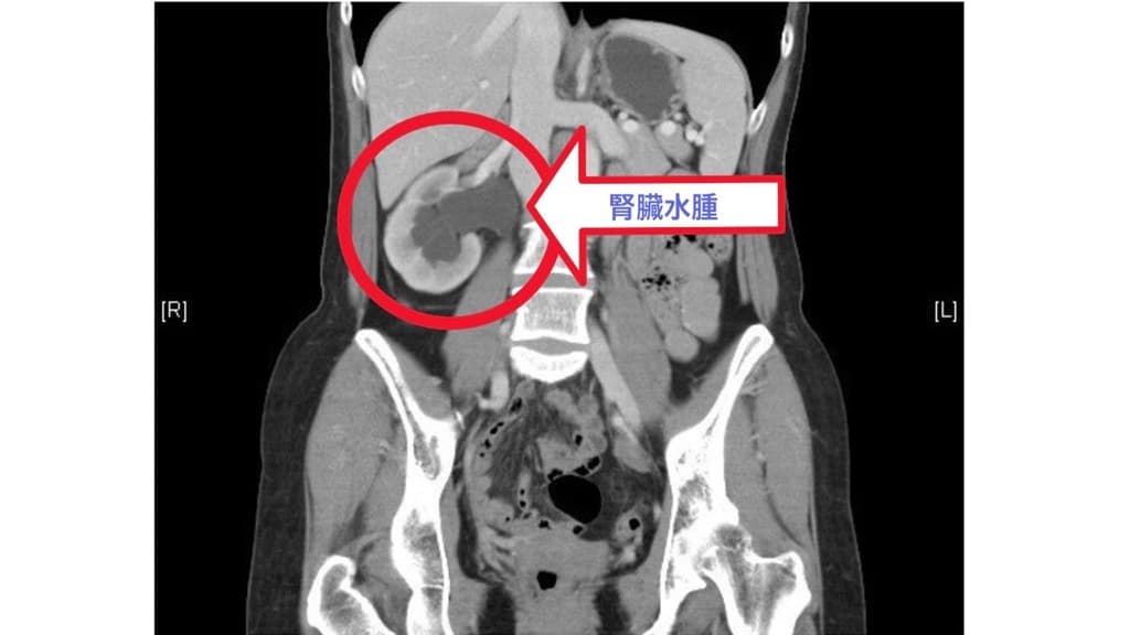 高血壓-維生素-腎臟病-腎水腫