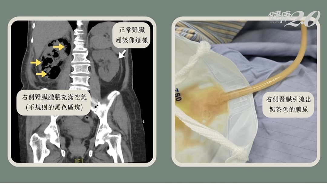 糖尿病-腎臟-血糖-腎盂腎炎