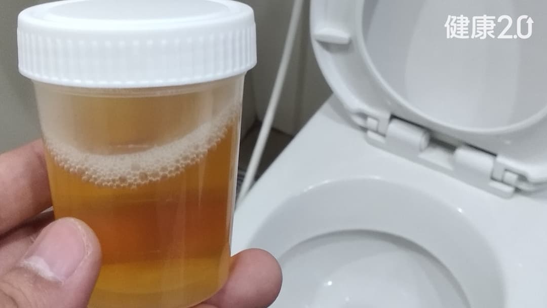 泡泡尿要不要緊-泡泡尿怎麼辦-要吃什麼-什麼少吃-戴定恩