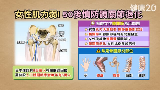 50+女性更容易關節炎！女性膝退化比男性高2倍 4招避免關節退化