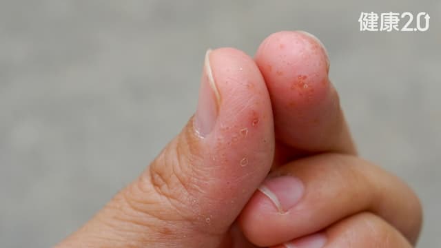 「汗皰疹」患者必看！中醫教你4招簡單預防 多喝1茶飲擺脫濕疹好簡單/tcm/354970