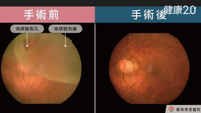 50歲女眼前一片黑長達2周還以為是飛蚊症 醫勸年紀越大要提高警覺/strong/355025