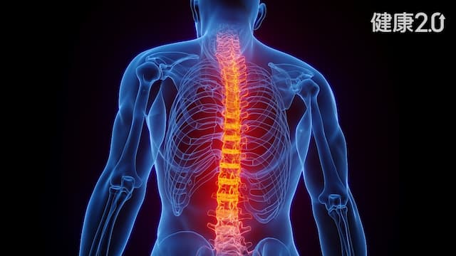 好多男星因僵直性脊椎炎免役？醫曝關鍵4症狀別拖 脊椎恐變形