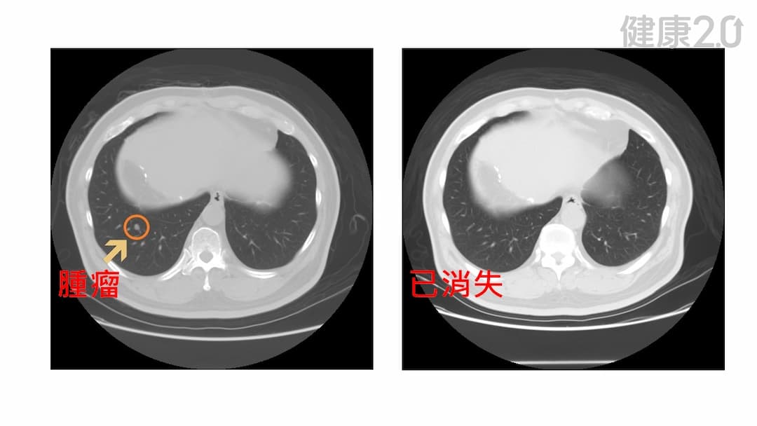 免疫療法-標靶治療-免疫標靶治療-肝癌-癌細胞-健保給付-副作用-中晚期