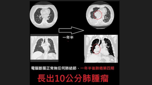 男急診驚見10公分大腫瘤 1年半長大26萬倍難早發現/cancer/355440