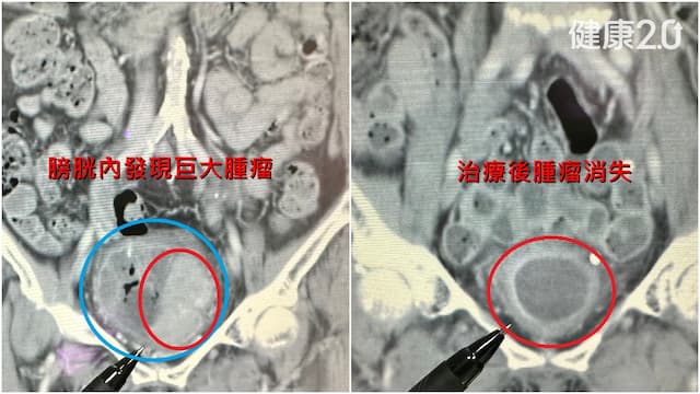 7旬婦無痛性血尿 無發炎、尿路結石 原來巨大膀胱癌作祟/cancer/355645