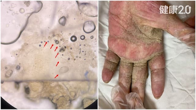 老翁全身爆癢擦藥膏也沒用！一刮竟驗出上千隻蟲 2招除疥蟲